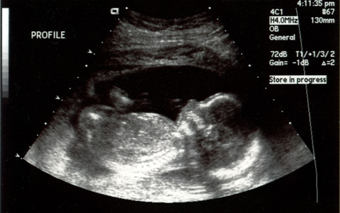 An ultrasound image of a baby, seen in profile.